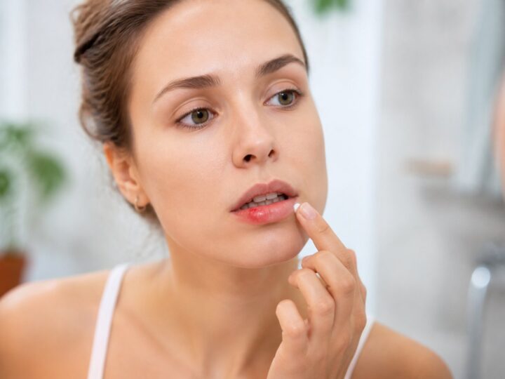 Como Secar Herpes Labial em Uma Noite: Métodos e Cuidados Profissionais